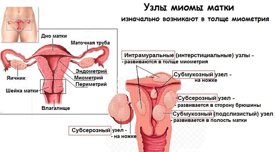 Классификация узлов миомы матки