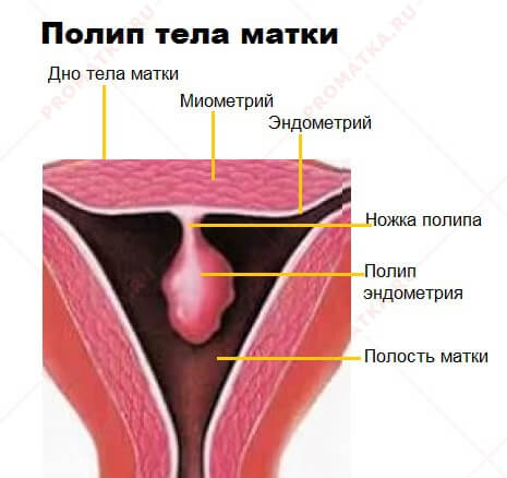 Полип эндометрия
