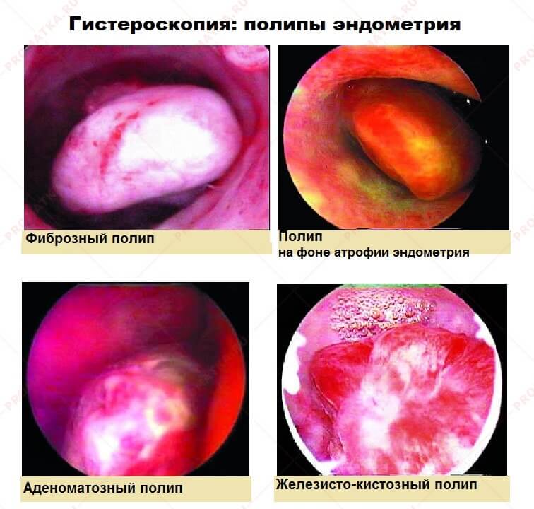 Гистероскопия: полипы эндометрия