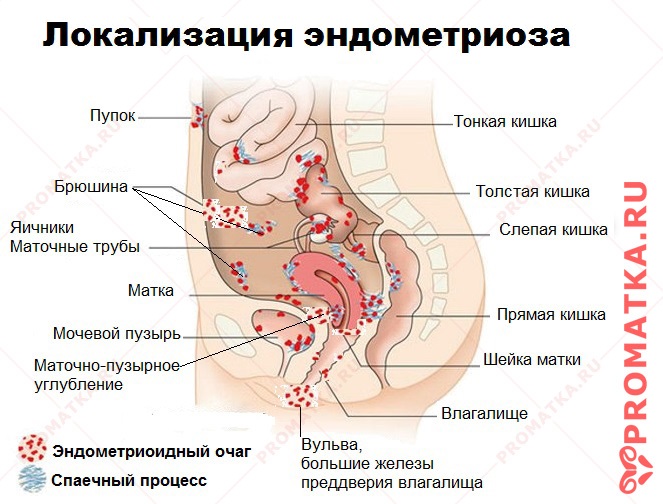 Локализация эндометриоза   