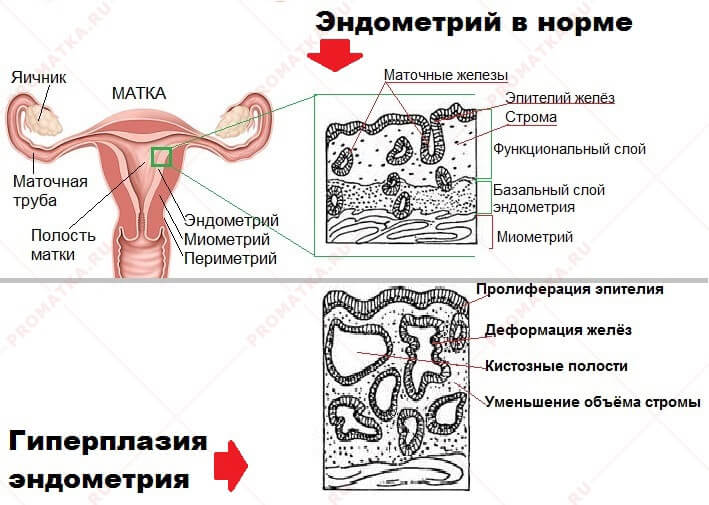 Схема гиперплазии эндометрия