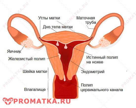 Беременность после полипа эндометрия 21