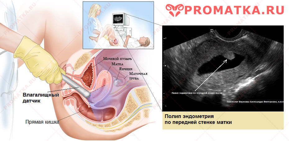 Беременность после полипа эндометрия 22