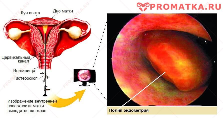 Беременность после полипа эндометрия 23