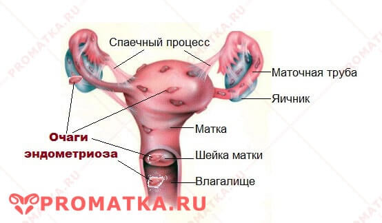 Эндометриоз матки 