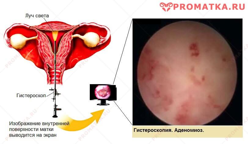 Эндометриоз матки гистероскопия 