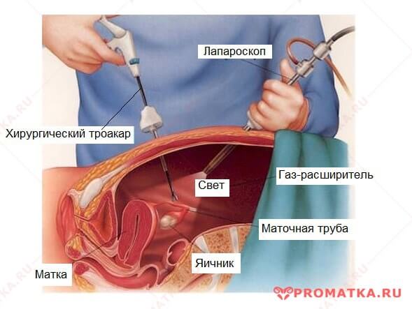 Эндометриоз яичника и герпес thumbnail