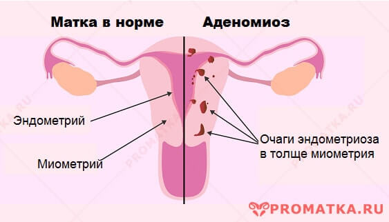 Внутренний эндометриоз 