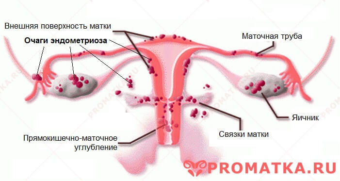 Наружный генитальный эндометриоз 