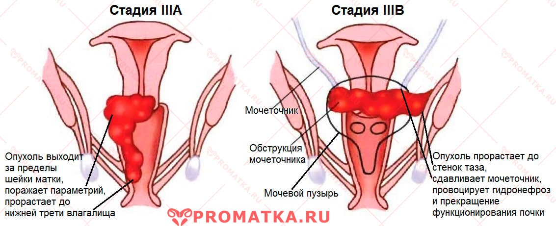 Рак шейки матки 3 стадии – схема