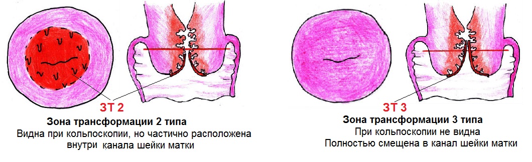 Кольпоскопическая картина 2 степени что значит